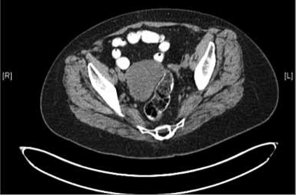 CT scan of pelvis demonstrating right ovarian cystic mass.